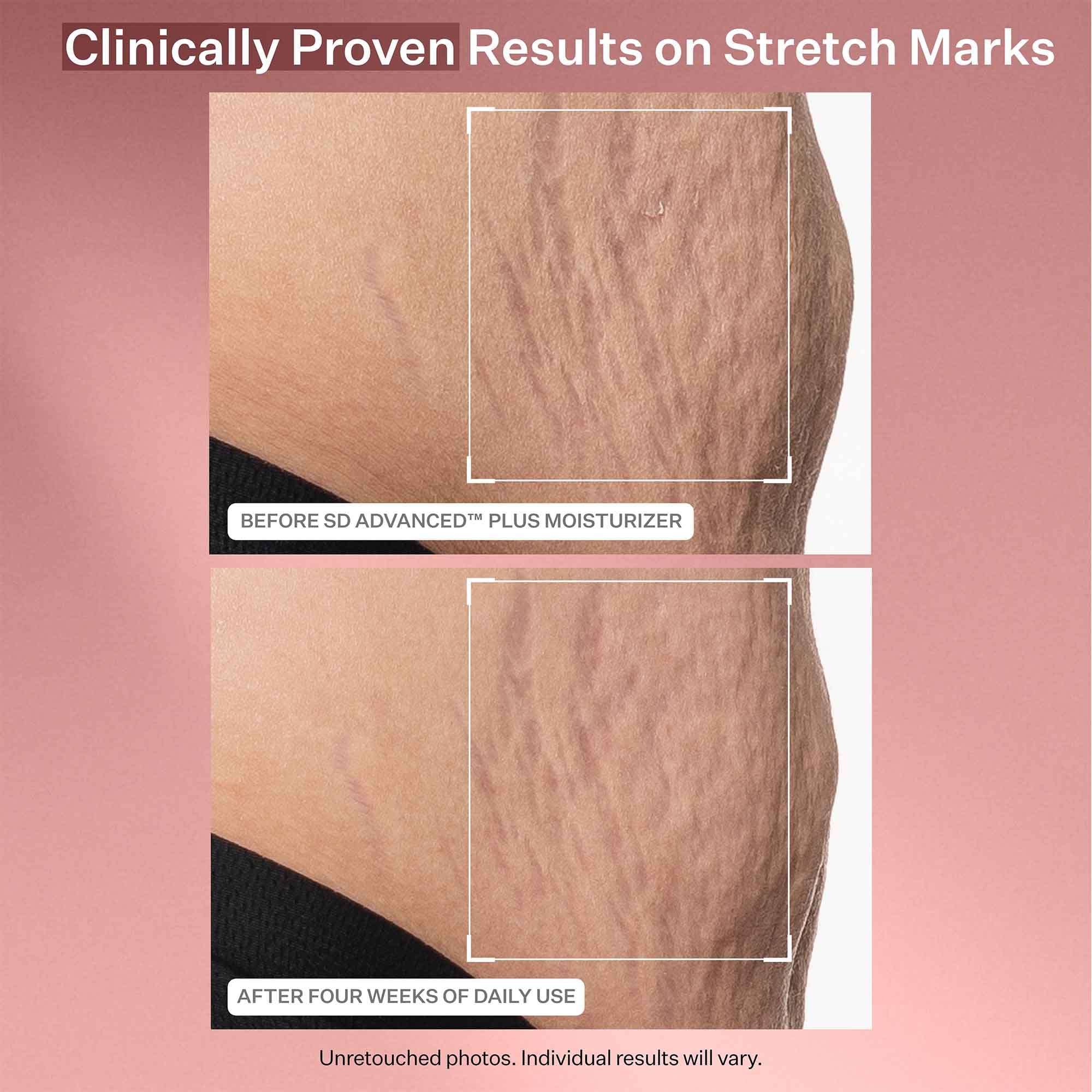 StriVectin SD Advanced Plus Intensive Moisturizer for Wrinkles & Stretch Marks with Peptides & Hyaluronic Acid